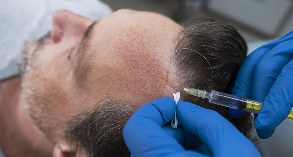 FUE Micro-grafts